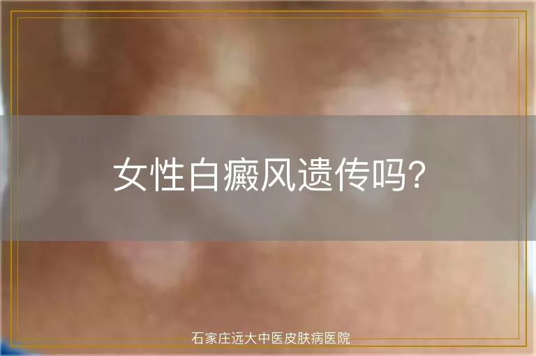 女性白癜风遗传吗？