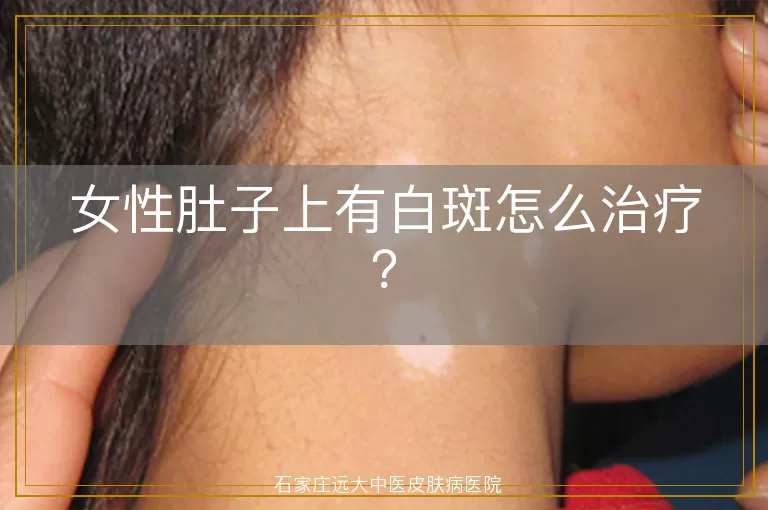女性肚子上有白斑怎么治疗？