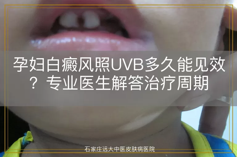 孕妇白癜风照UVB多久能见效？专业医生解答治疗周期