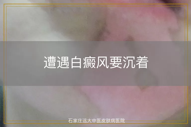 遭遇白癜风要沉着
