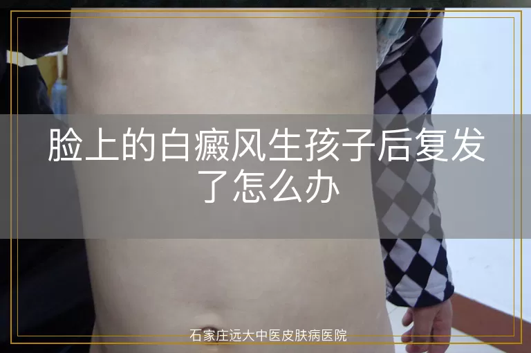 脸上的白癜风生孩子后复发了怎么办