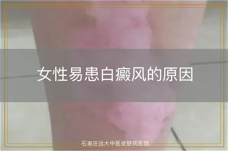 女性易患白癜风的原因