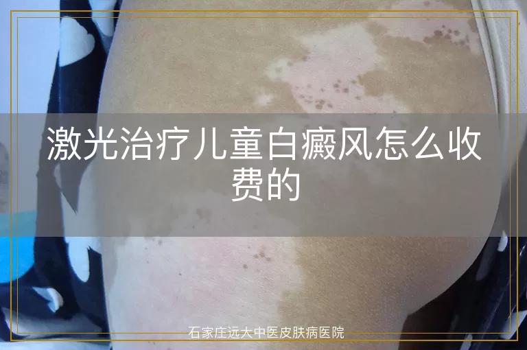 激光治疗儿童白癜风怎么收费的