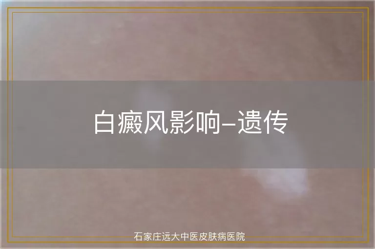 白癜风影响-遗传