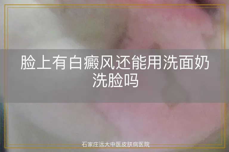脸上有白癜风还能用洗面奶洗脸吗