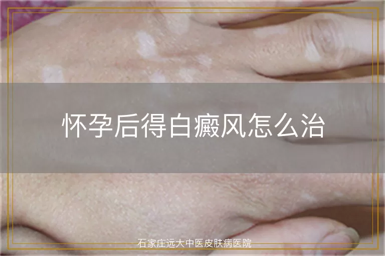 怀孕后得白癜风怎么治