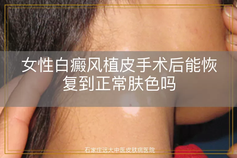 女性白癜风植皮手术后能恢复到正常肤色吗