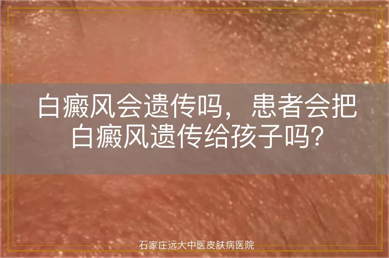 白癜风会遗传吗，患者会把白癜风遗传给孩子吗？