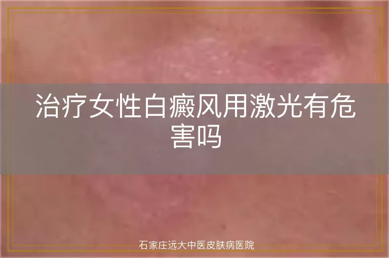 治疗女性白癜风用激光有危害吗