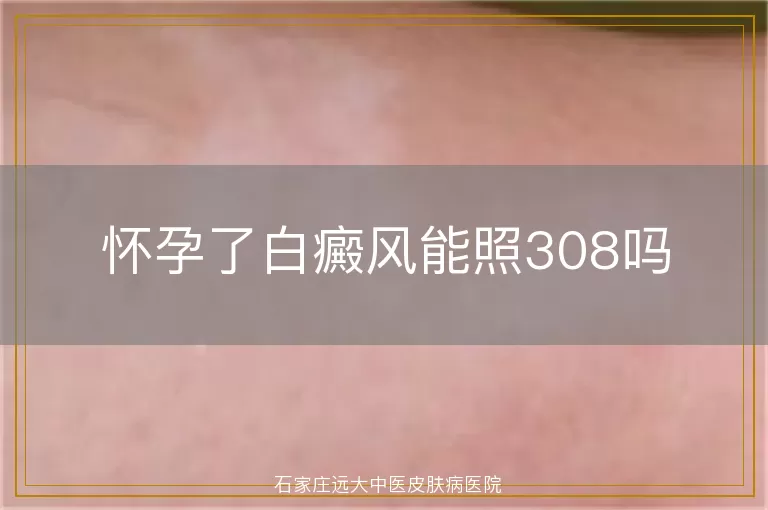 怀孕了白癜风能照308吗