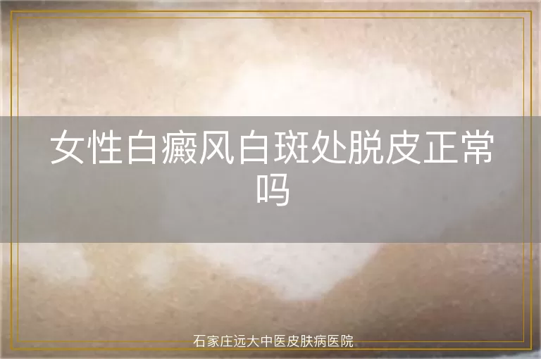 女性白癜风白斑处脱皮正常吗