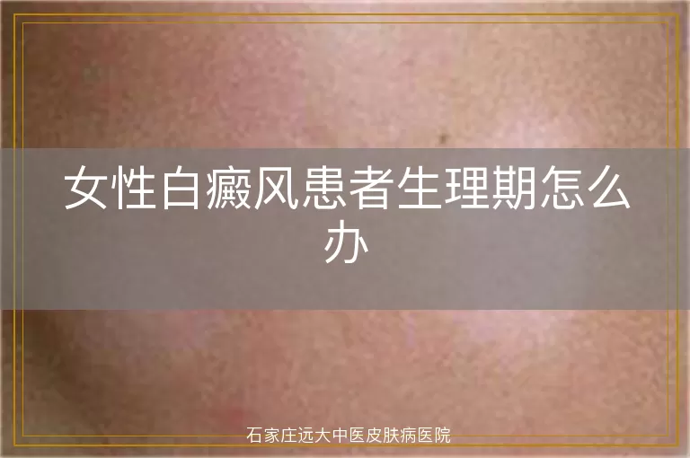 女性白癜风患者生理期怎么办