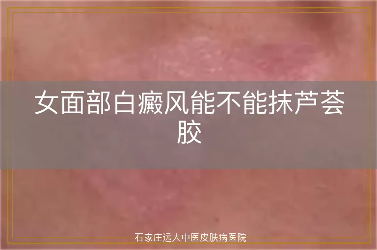 女面部白癜风能不能抹芦荟胶
