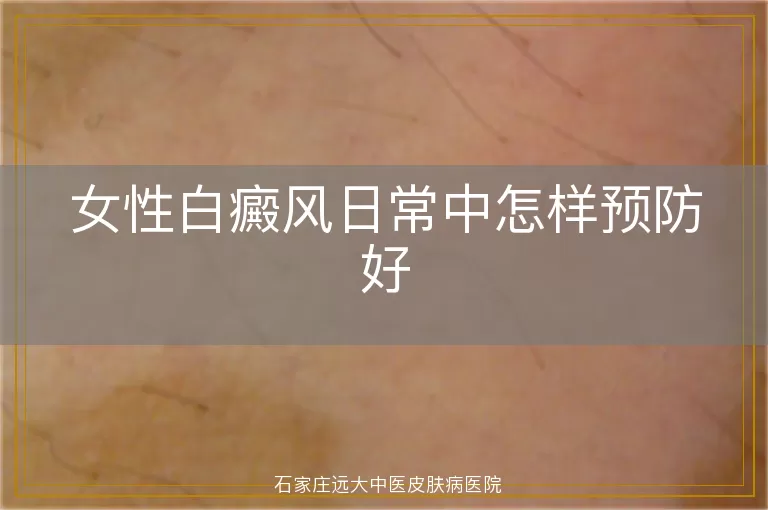 女性白癜风日常中怎样预防好