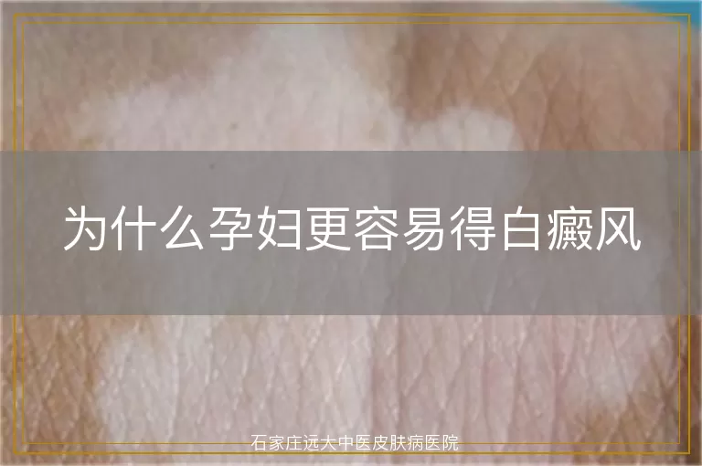 为什么孕妇更容易得白癜风