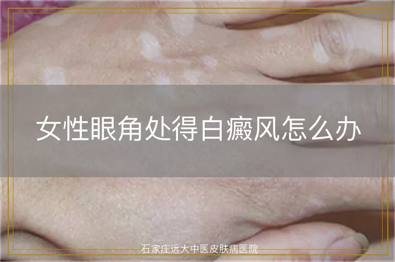 女性眼角处得白癜风怎么办