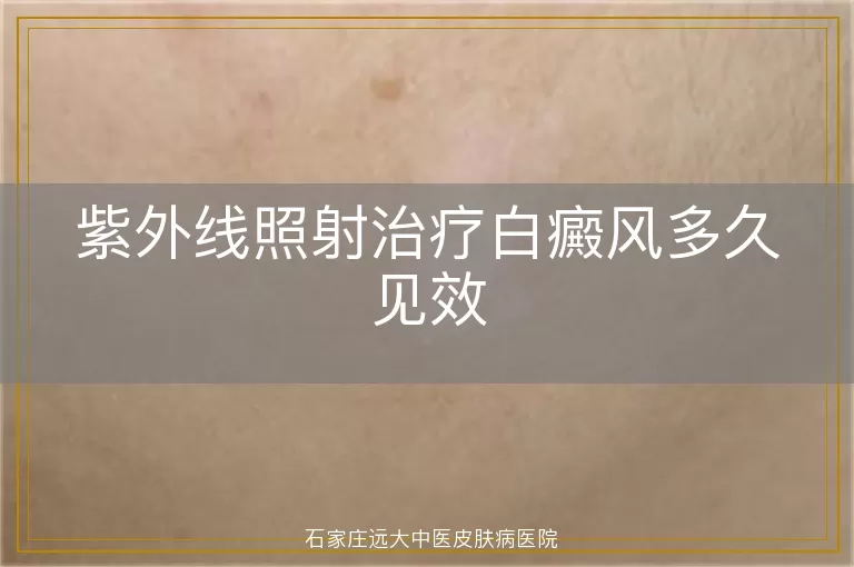 紫外线照射治疗白癜风多久见效
