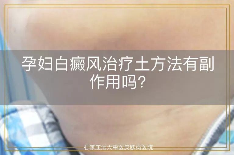 孕妇白癜风治疗土方法有副作用吗?