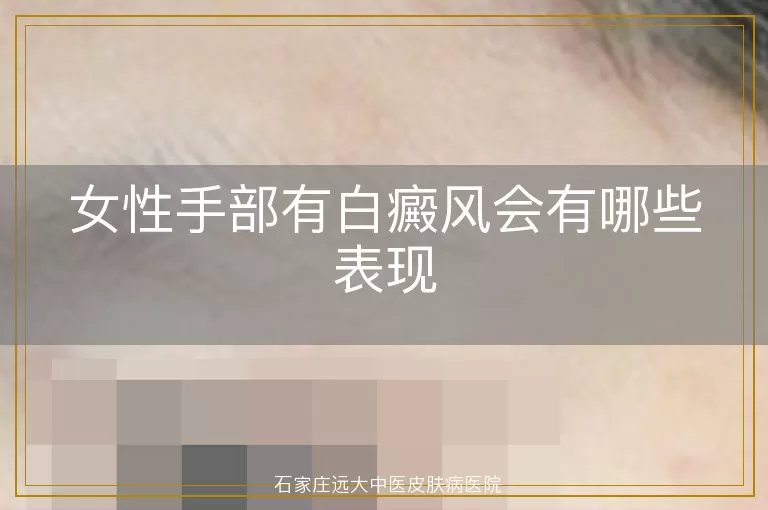 女性手部有白癜风会有哪些表现