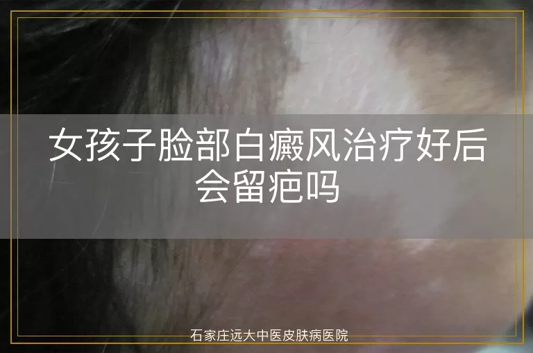 女孩子脸部白癜风治疗好后会留疤吗