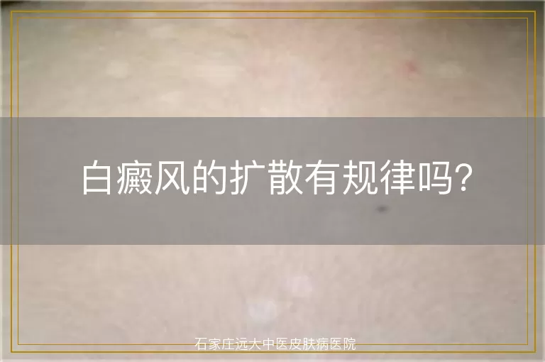 白癜风的扩散有规律吗？