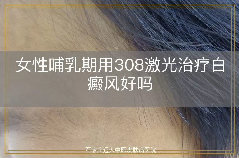 女性哺乳期用308激光治疗白癜风好吗