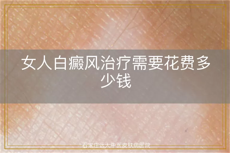 女人白癜风治疗需要花费多少钱