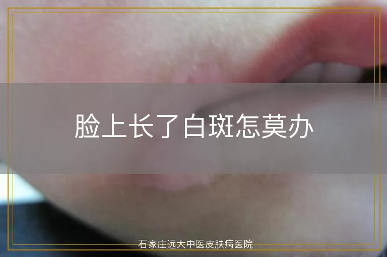 脸上长了白斑怎莫办