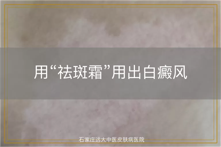 用“祛斑霜”用出白癜风