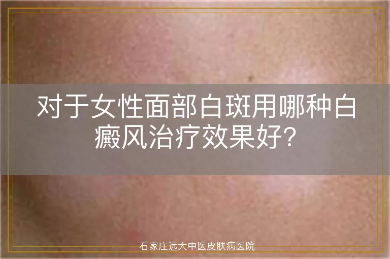 对于女性面部白斑用哪种白癜风治疗效果好?