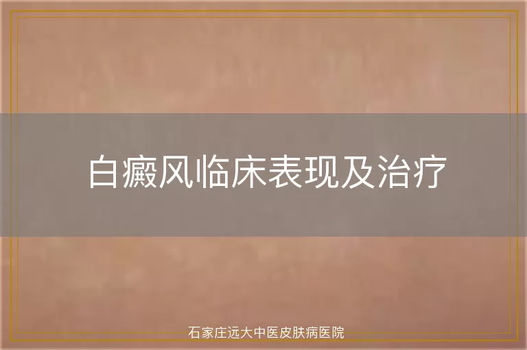 白癜风临床表现及治疗