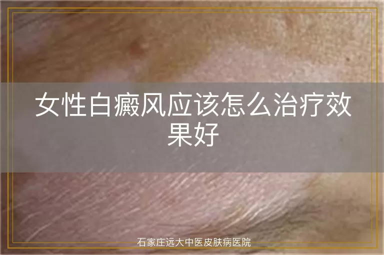 女性白癜风应该怎么治疗效果好