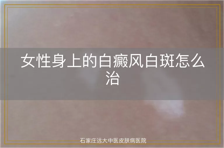 女性身上的白癜风白斑怎么治