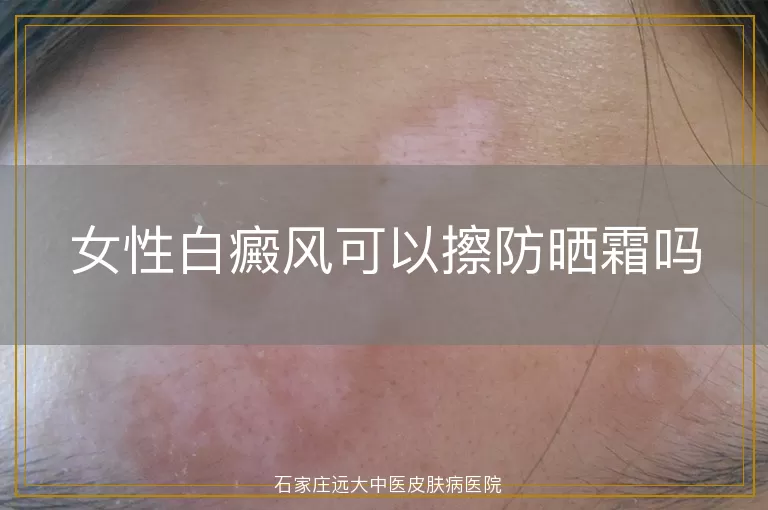 女性白癜风可以擦防晒霜吗