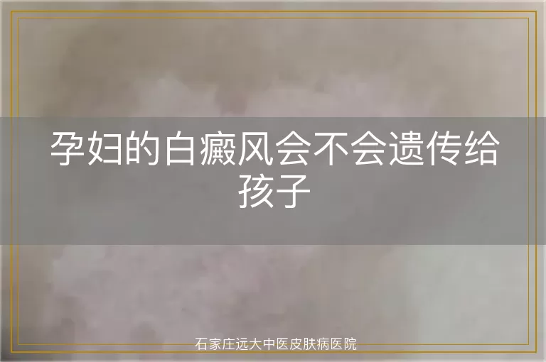 孕妇的白癜风会不会遗传给孩子