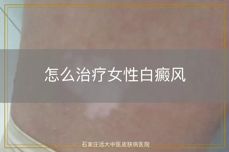 怎么治疗女性白癜风
