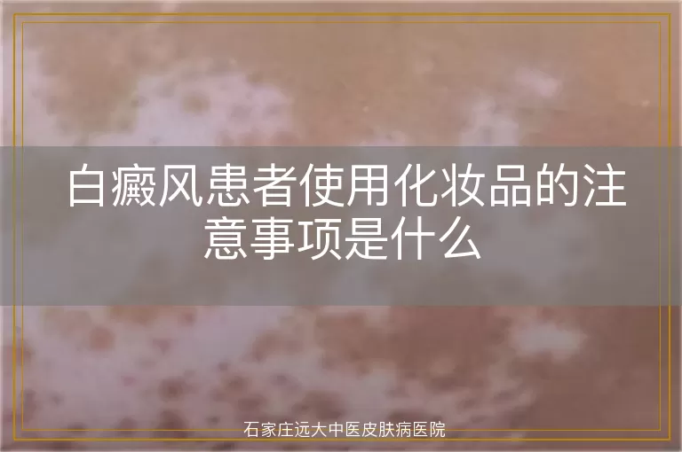 白癜风患者使用化妆品的注意事项是什么
