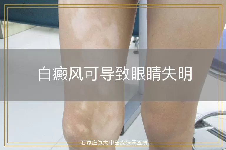 白癜风可导致眼睛失明