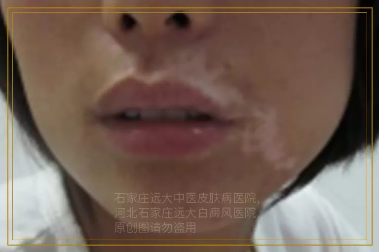 孕妇散发型白癜风照uvb能治得好吗