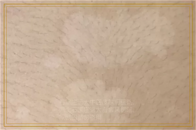 女性如何正确治疗自己的白癜风