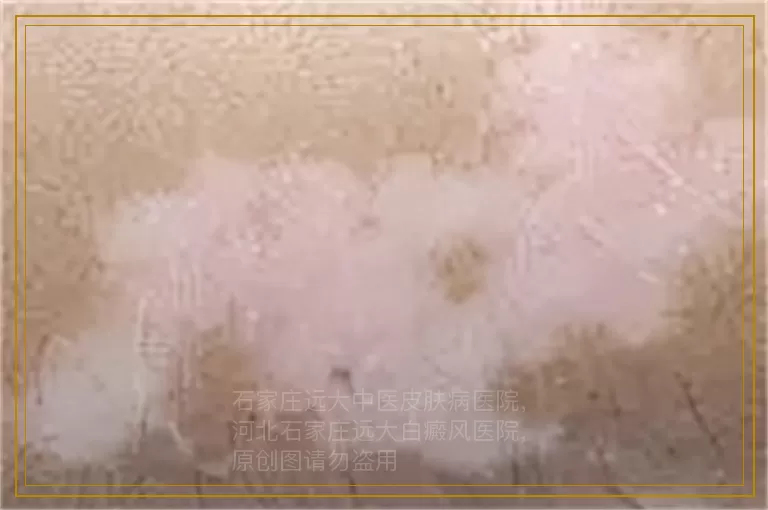 白斑病的治疗与预防