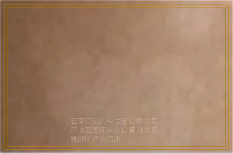 女性白癜风与内分泌紊乱有关吗
