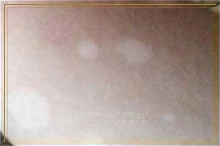 女性屁股沟有白斑是怎么回事