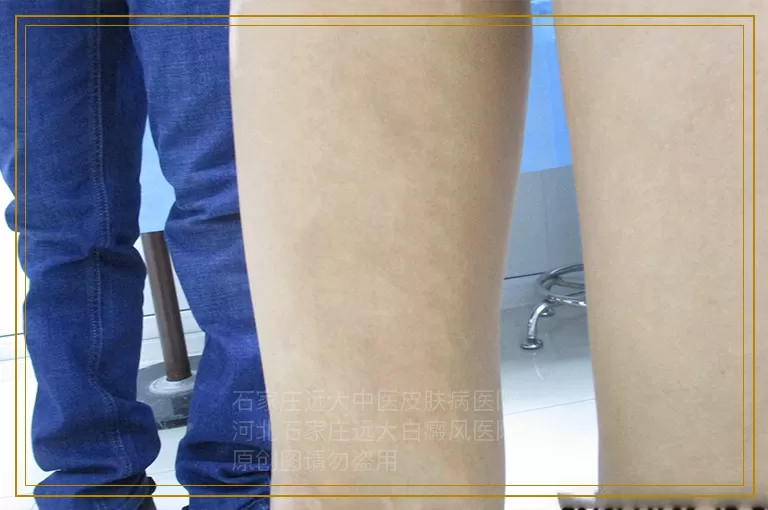 女性颈部白癜风照完激光很黑的图片原因说明