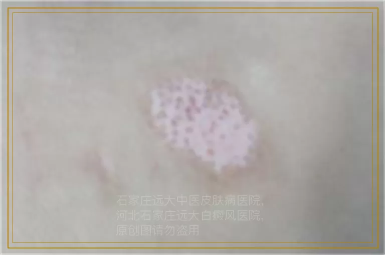 石家庄女性脸上的白癜风怎么治疗