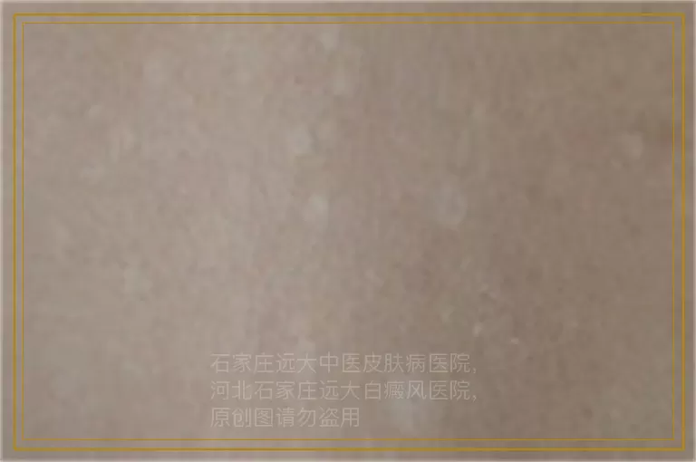 刚刚怀孕发现有白癜风怎么办