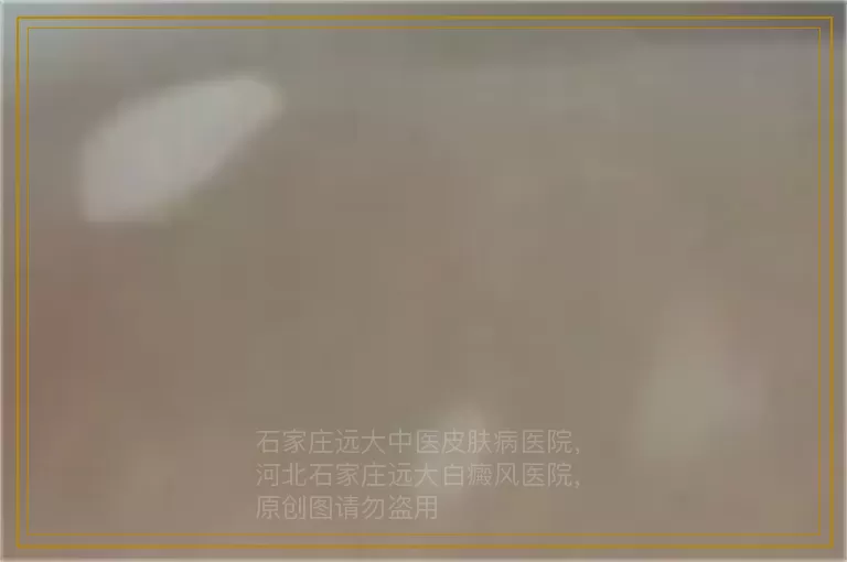 怀孕期间发现白癜风可怎么办