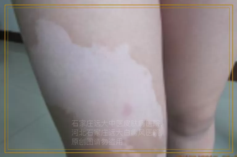 女性白癜风患者的高发部位是哪