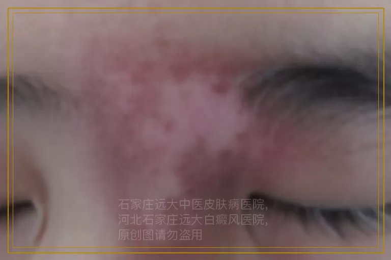 怀孕后有白癜风可以照308激光