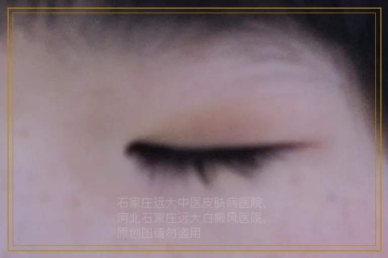 怀孕的时候手上有白斑可以照308吗